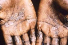 penyakit-monkeypox-34